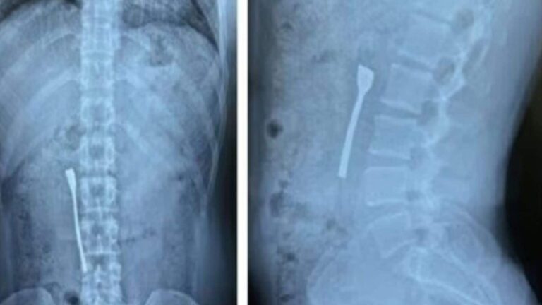 पेट दर्द बना मुसीबत! दिल्ली के युवक के पेट से निकली 8 cm लंबी चम्मच