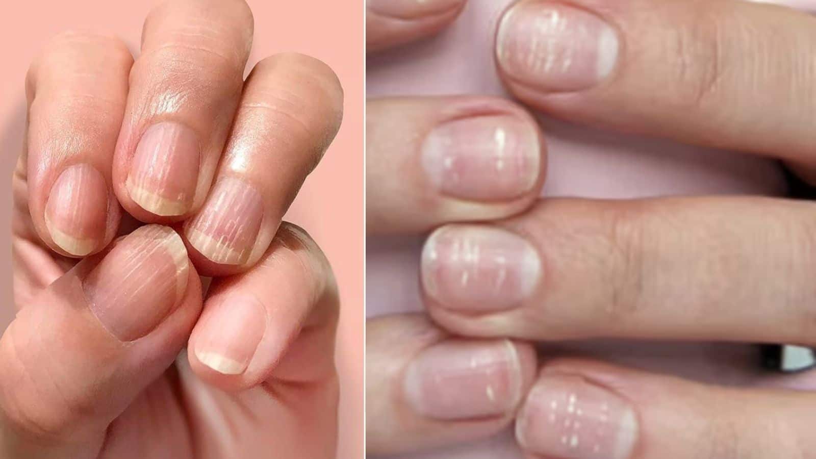  Health alert: नाखूनों की लकीरें बता रही हैं सेहत की सच्चाई, जानिए क्या है वजह