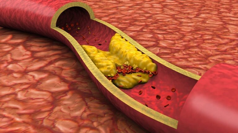 High Cholesterol: बिना दवा कोलेस्ट्रॉल होगा छूमंतर! बस अपनाएं ये घरेलू जुगाड़