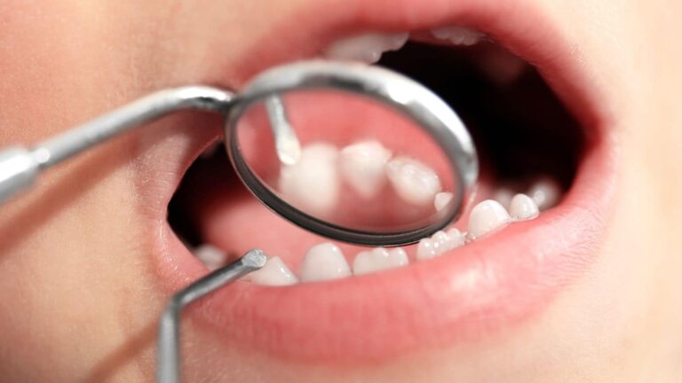 दांतों में कीड़ा बन गया सिरदर्द? ये आसान नुस्खा आजमाएं, फर्क खुद देखेंगे!