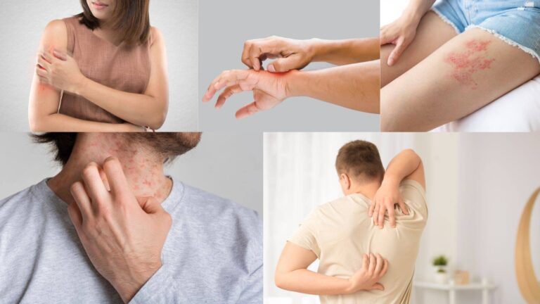 Skin care in rainy season: बारिश शुरू, स्किन पर रैशेज और खुजली का हमला! बचने के लिए ये है इलाज