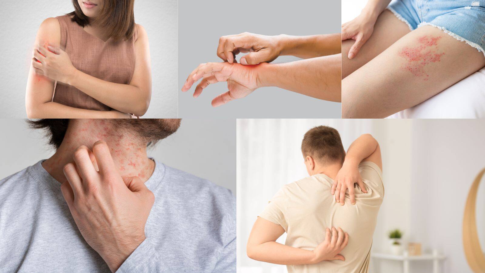 Skin care in rainy season: बारिश शुरू, स्किन पर रैशेज और खुजली का हमला! बचने के लिए ये है इलाज