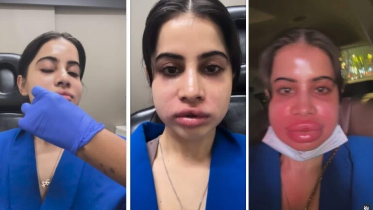 Urfi Javed Lip Filler: लिप फिलर हटाने के बाद हुआ उर्फी जावेद का हाल बेहाल, चेहरा देख लोगों को हुई चिंता