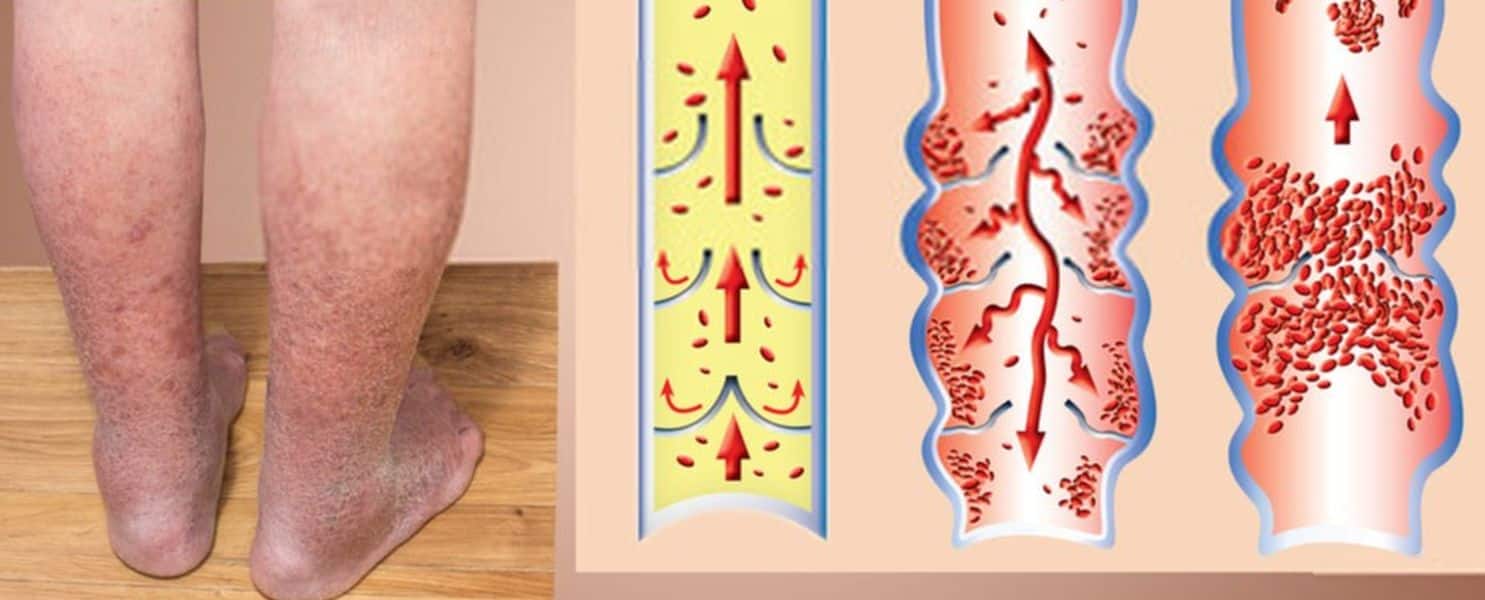 Vein Thrombosis: नसों की जिस बीमारी से अमेरिकी राष्ट्रपति जूझ रहे हैं, उसके क्या है लक्षण और कैसे आप कर सकते हैं बचाव