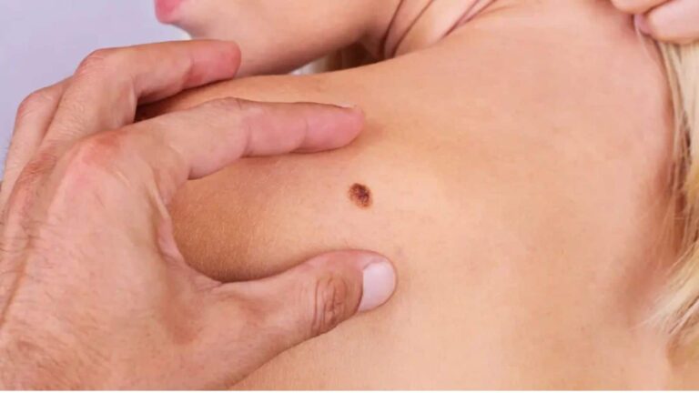 beta-HPV: ये आम वायरस भी बन सकता है आपके लिए जानलेवा! अंदर-अंदर ही बढ़ जाता है स्किन कैंसर का खतरा
