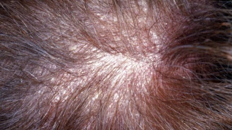 आखिर क्यों जम रही है खोपड़ी पर डैंड्रफ की परत? जानें एक्सपर्ट्स की राय और इसका कारण!