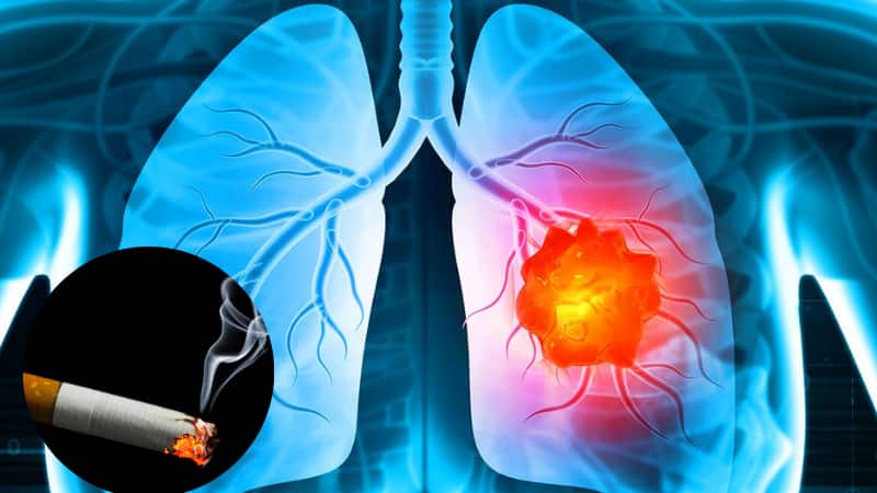 Lung Cancer: फेफड़ों का कैंसर अब सिर्फ स्मोकर्स तक सीमित नहीं, खतरा सब पर मंडरा रहा है!