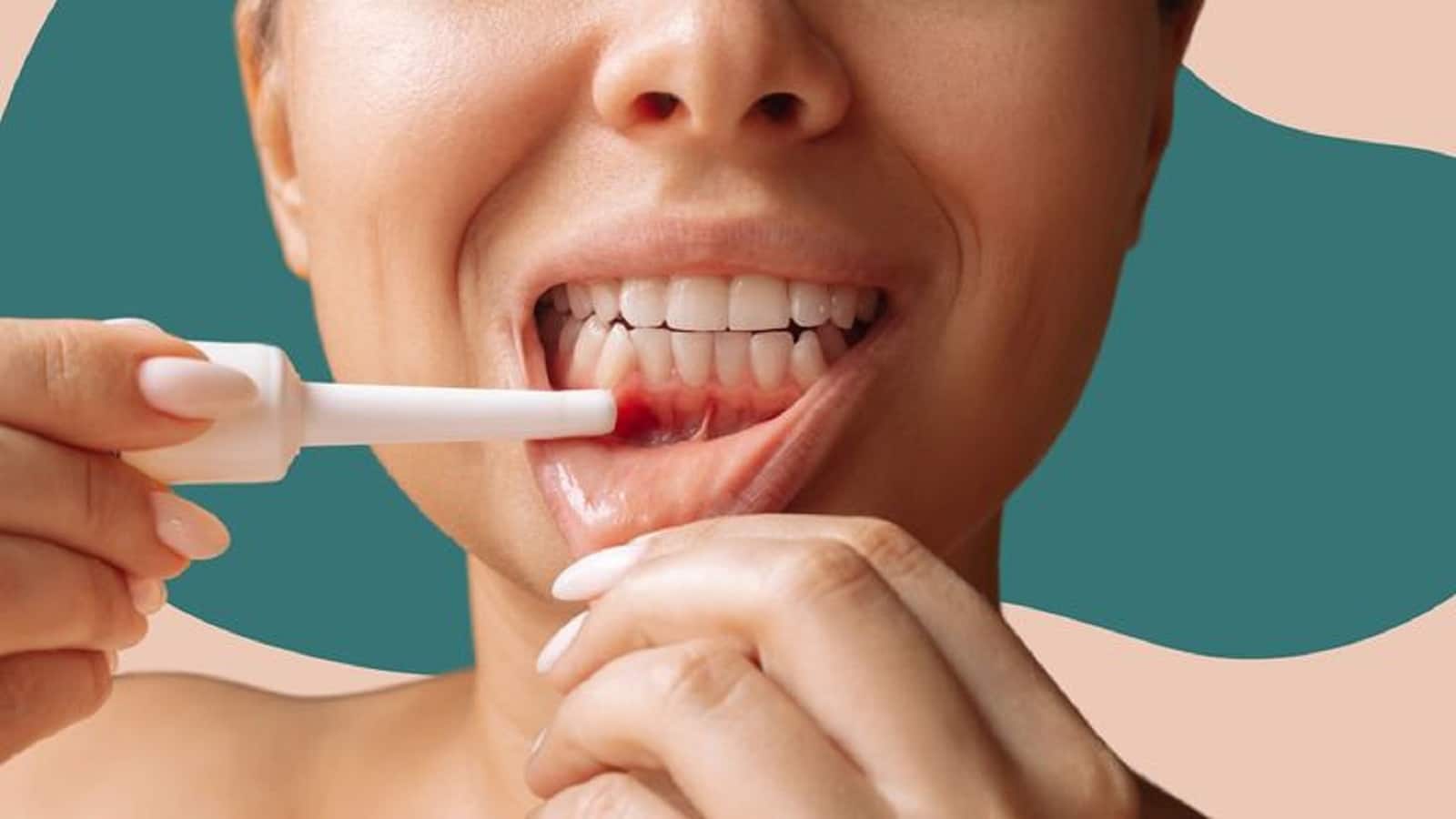 Mouth Ulcer Relief Tips: दर्द भरे छालों में तुरंत आराम पहुंचाएंगे ये 5 आसान और घरेलू उपाय