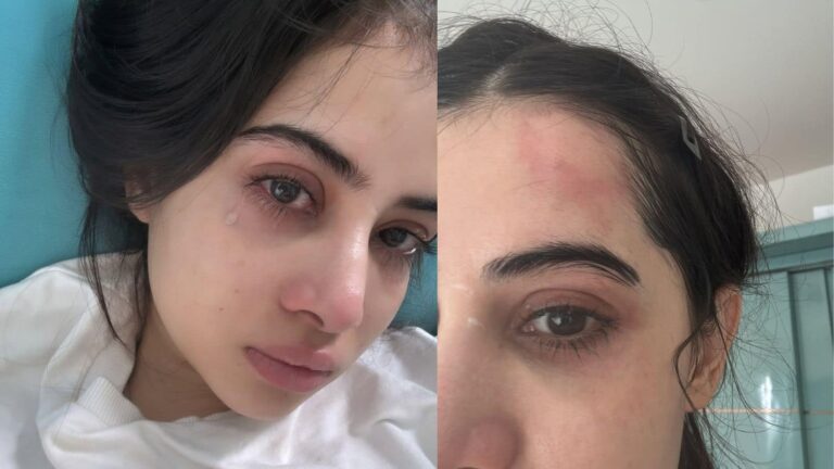 Urfi Javed को क्या हुआ? शेयर की सिर पर चोट और आंखों में आंसू वाली फोटो