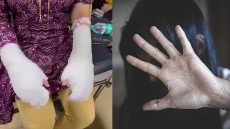 Delhi: एसिड अटैक में डीयू की छात्रा के दोनों हाथ बुरी तरह झुलसे, पीड़िता ने सुनाई आपबीती, दिल्ली में योगी मॉडल की उठी मांग