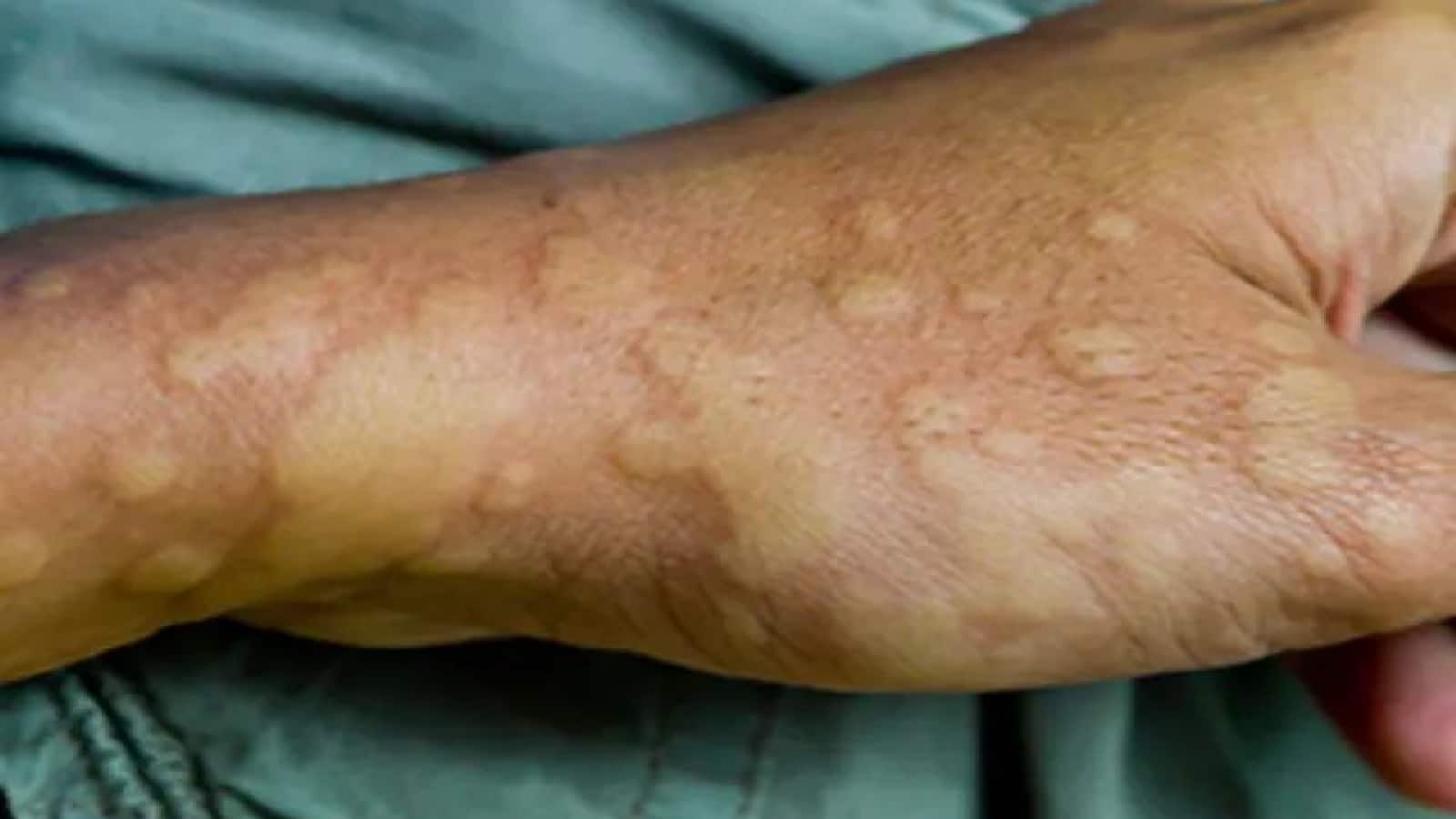 शरीर पर अचानक उभर आते हैं चकत्ते तो ये उपाय आएंगे आपके काम, जानें नेशनल अवॉर्ड विनिंग डर्मेटोलॉजिस्ट की सलाह