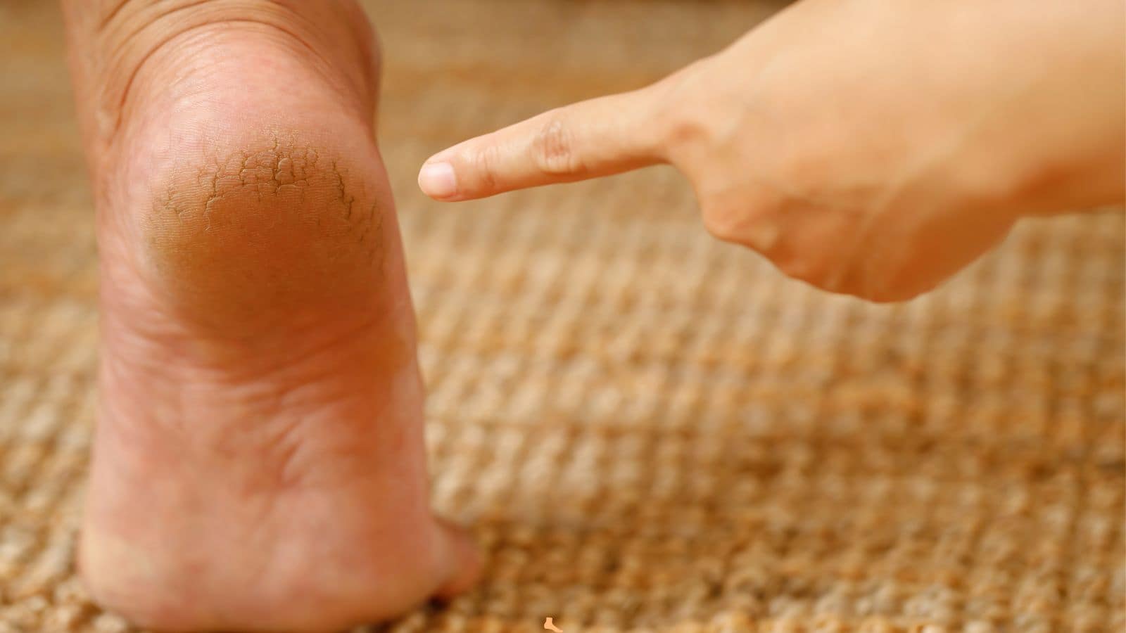 How To Use Glycerin: घर पर फटी एड़ियों का कमाल का इलाज, तुरंत असर देखें!