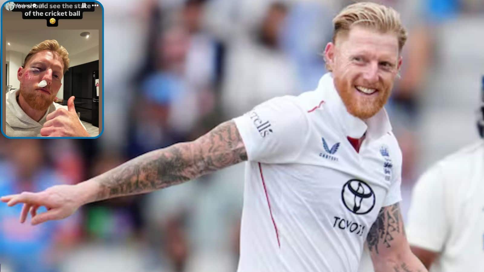 Ben Stokes Injury: गाल-आंख पर चोट के निशान, इंग्लैंड के कप्तान का बुरा हाल... हुए इंजर्ड