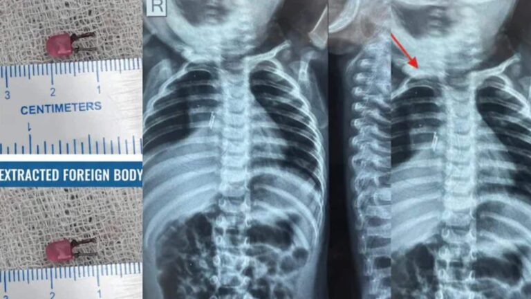 Gujarat: एक साल के बच्चे की सांस की नली से निकला LED बल्ब! डेढ़ महीने से बीमार था बच्चा