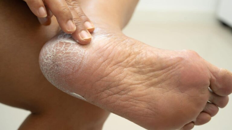 फटी एड़ियों से परेशान? आलू का यह देसी नुस्खा कर देगा कमाल