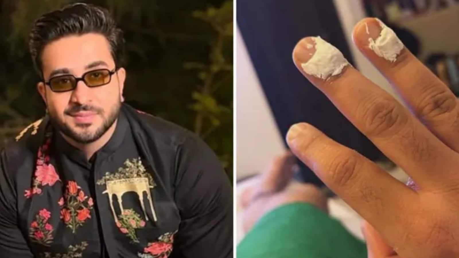 Aly Goni: लाफ्टर शेफ्स 3 के सेट पर अली गोनी का हाथ जला, बोले- 'पकौड़े की जगह, हाथ फ्राई कर दिया'