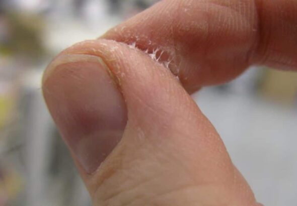 फेवीक्विक चिपक जाए उंगलियों पर तो न करें पैनिक! जानिए आसान हटाने का तरीका