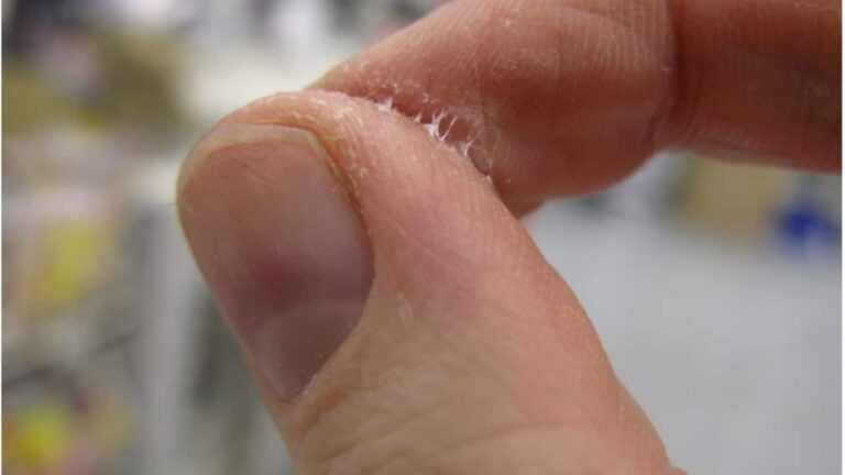 फेवीक्विक चिपक जाए उंगलियों पर तो न करें पैनिक! जानिए आसान हटाने का तरीका