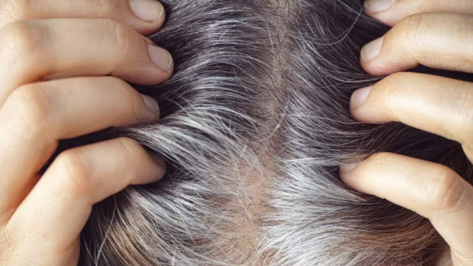 क्या जवानी में ही सफेद हो रहे हैं आपके बाल? आयुर्वेद डॉक्टर ने बताया कि किचन की कौन सी चीजें हैं बालों की दुश्मन